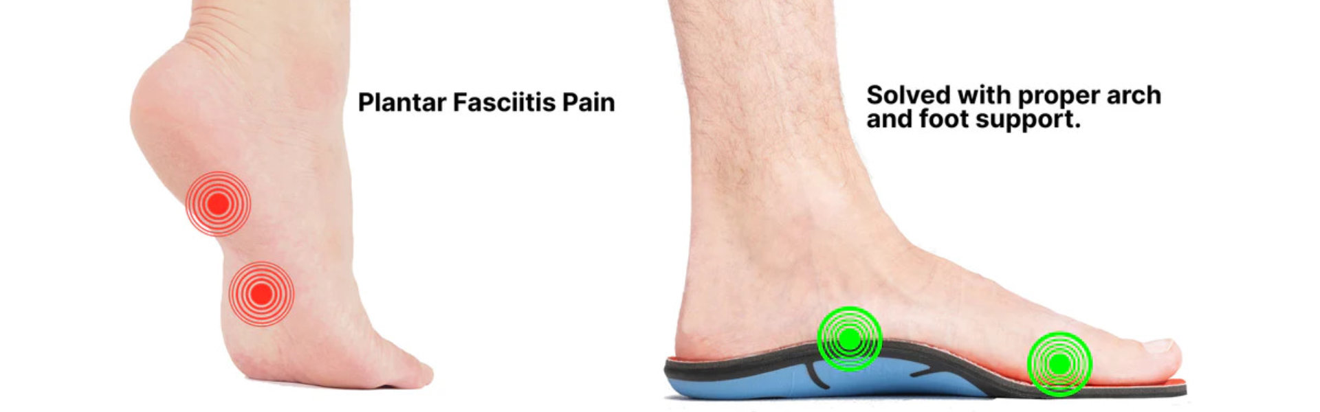 Sample picture of Plantar Fasciitis Pain and Solution